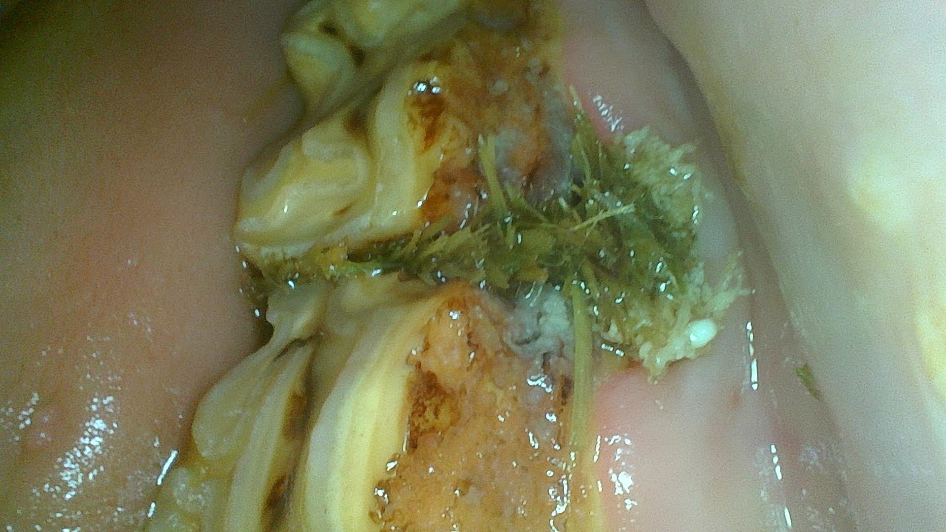 Endoscopisch beeld van een diastema bij een paard met voedselhoping en ontstoken tandvlees tussen twee aangrenzende kiezen